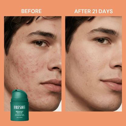 FreshLabs Breakout Rescue Acne Serum, 30ml